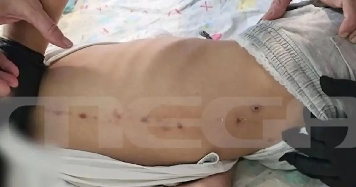 Αναπάντητα ερωτήματα με τα σημάδια στην πλάτη 7χρονου ΑμεΑ στην Πάτρα